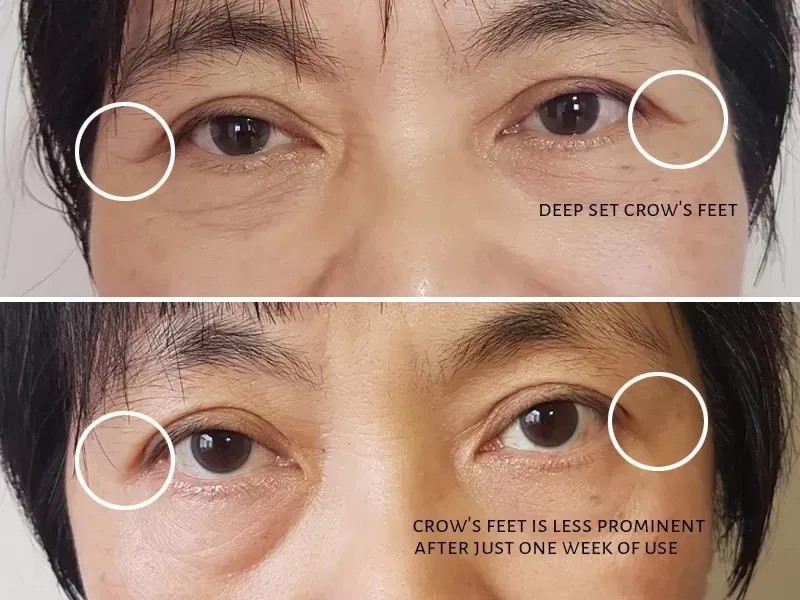 before after Eye Cream LOREAL revitalift
